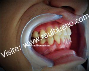 DESPUÉS DEL TRATAMIENTO