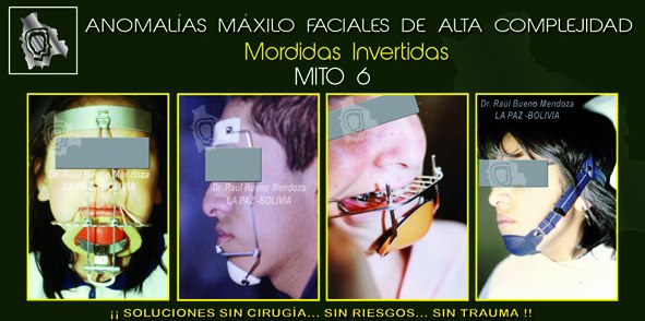 Lee más sobre el artículo Mordidas Invertidas – MITOS